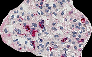 CD68（巨噬細(xì)胞）的腎小球占比自動(dòng)分析
